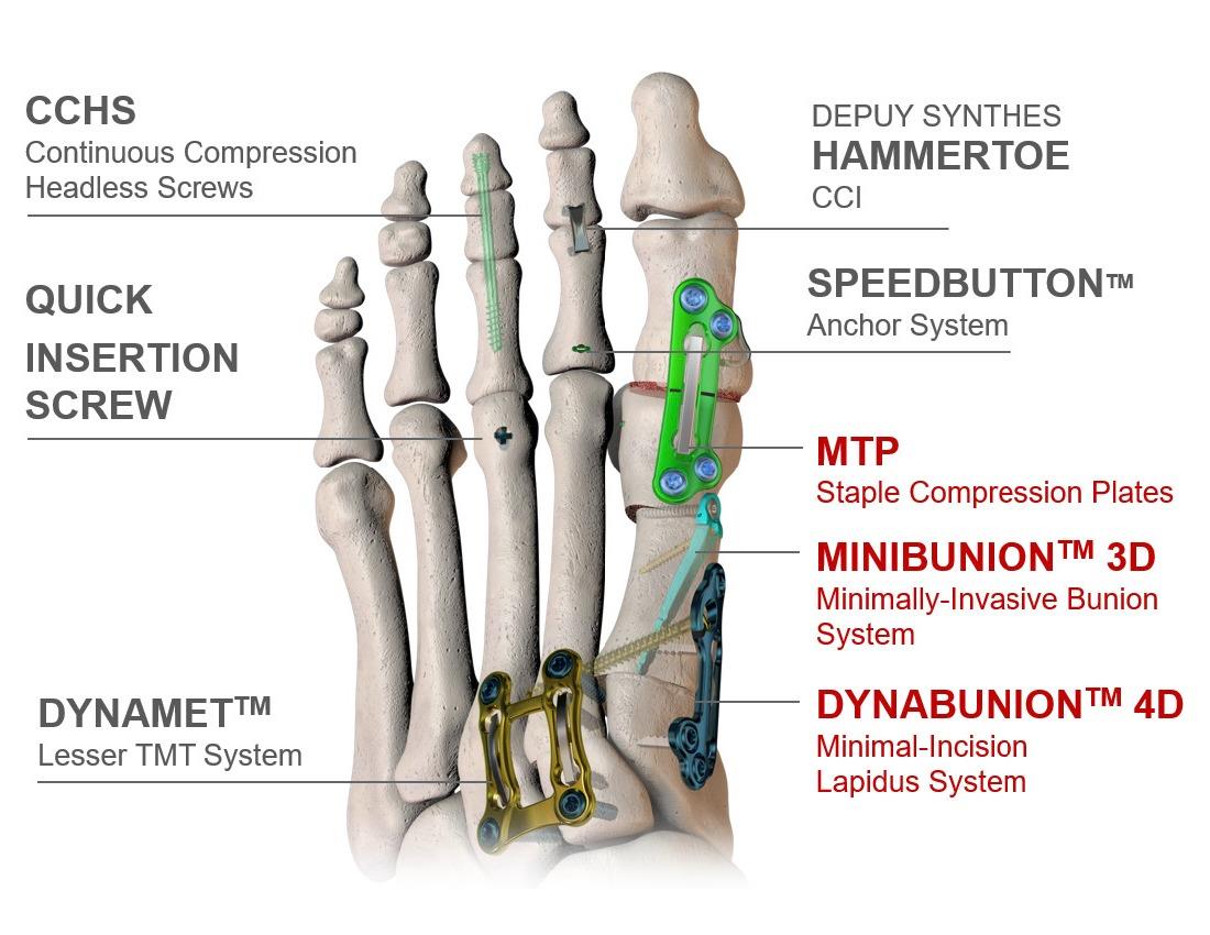 FootInnovate.com :: DePuy Synthes Foot & Ankle